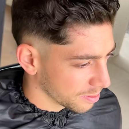 Fede Valverde mostrando cicatriz na cabeça após briga no Real Madrid